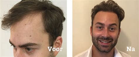 De Impact Van Leefstijl Op Haartransplantatie Resultaten