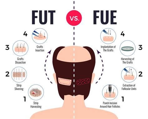 Haartransplantatie Technieken: Wat Is Het Beste?