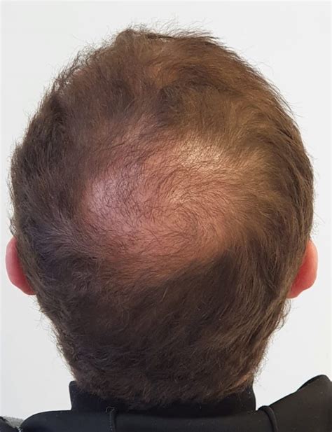 Hoeveel Kans Heb Je Op Succes Met Een Haartransplantatie?