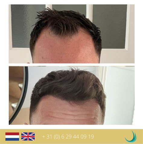 Zorg Voor Je Haar Na Een Haartransplantatie