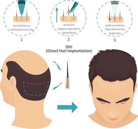 Haartransplantatie DHI: Hoe Het Verschilt Van Traditionele Methoden