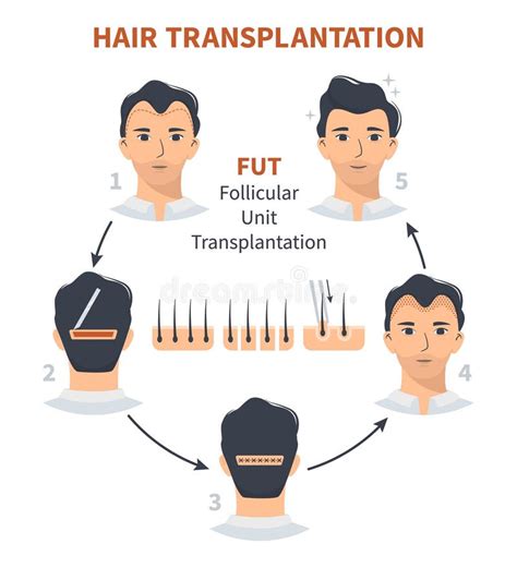 De Rol Van Technologie In Haartransplantatie Innovaties