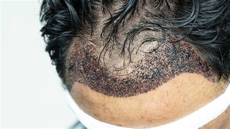 Een Haartransplantatie Plan Maken: Stap Voor Stap