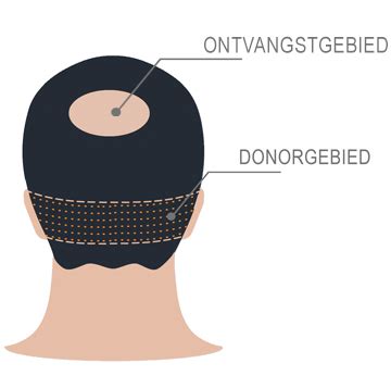 Haartransplantatie: Professionele Aanbevelingen En Adviezen