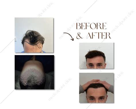 Haartransplantatie En Bijwerkingen: Wat Te Verwachten