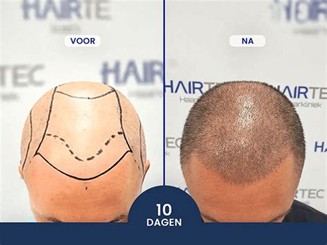 Haartransplantatie En Genetica: Wat Maakt Het Verschil?