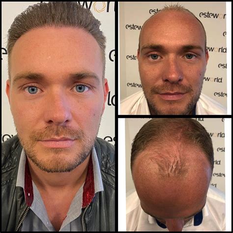 Haartransplantatie Het Beste Voor Jou? Een Besluitvormingsgids