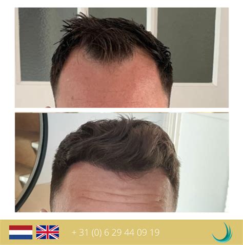 Het Proces Van Haartransplantatie: Stapsgewijs Uitleg