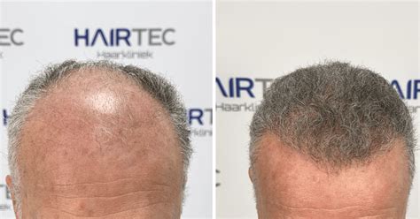 Hoelang Duurt Het Herstel Na Haartransplantatie?