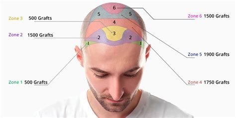Kostenanalyse: Haartransplantatie In Verschillende Landen
