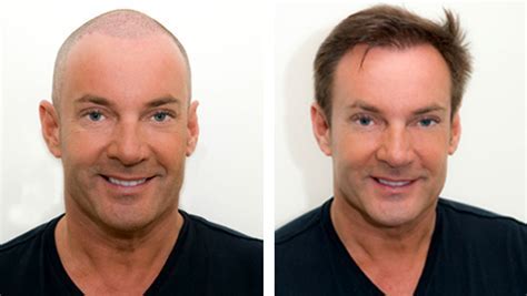 Na Zorg Voor Je Haartransplantatie Behandeling