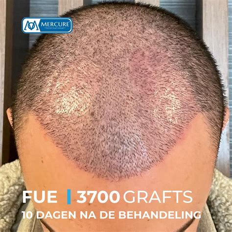 Saffier FUE: Een Innovatieve Benadering Van Haartransplantatie